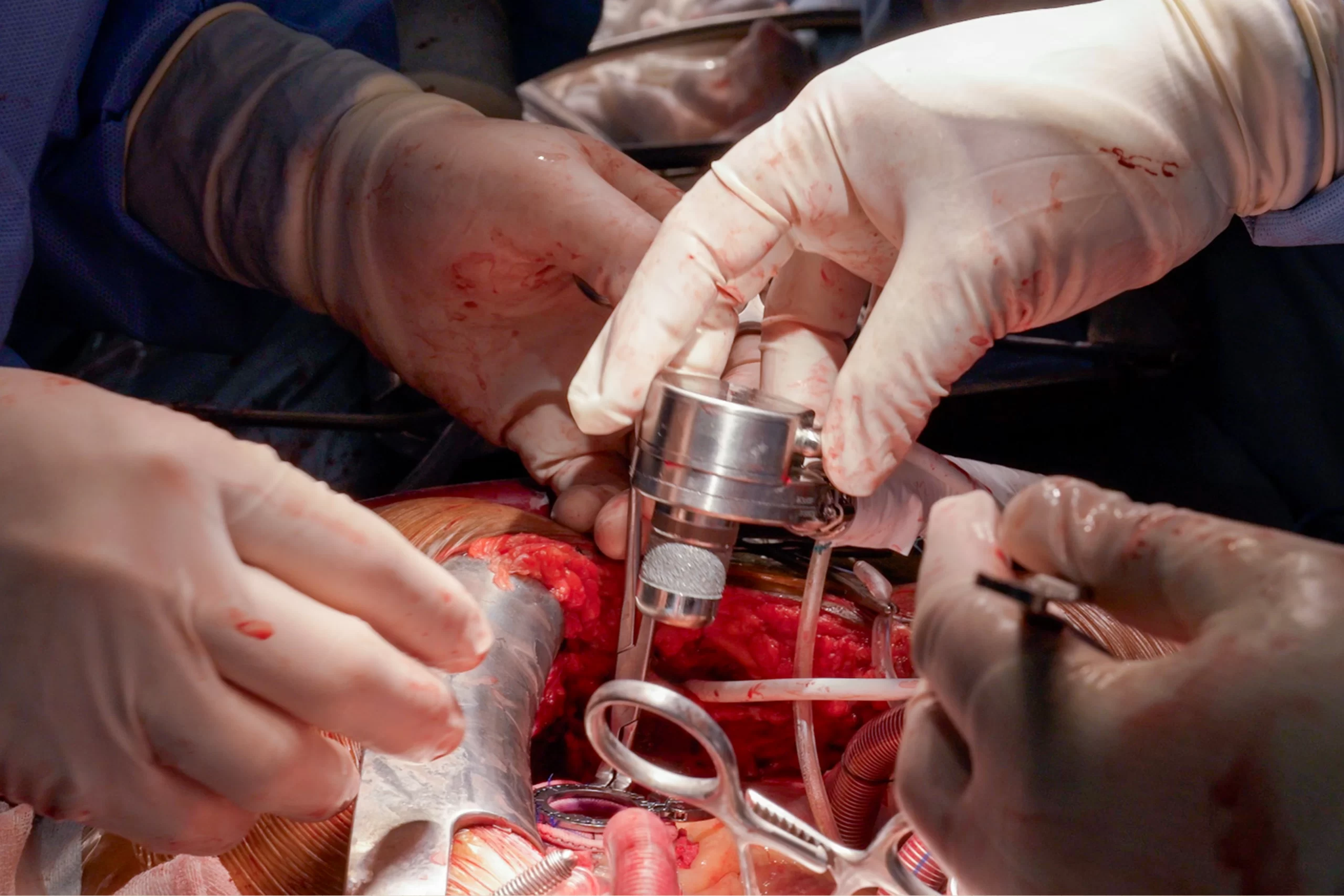 6-LVAD-Implantation-Surgery